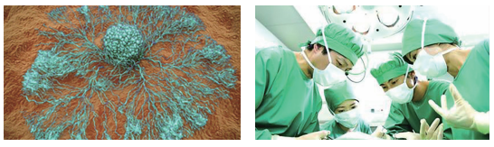 为什么有些患者手术后还会转移-